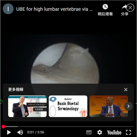 UBE for high lumbar vertebrae via pedicle approach: Everything for thornness