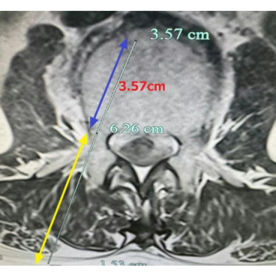 How to handle UBE intervertebral space, UBE intervertebral space preparation, and UBE fusion intervertebral space clearance