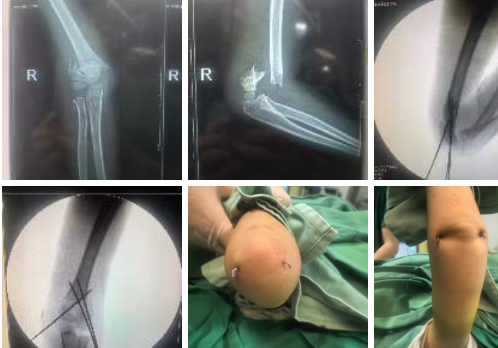 Late-night emergency: For the sake of the child, we chose minimally invasive surgery